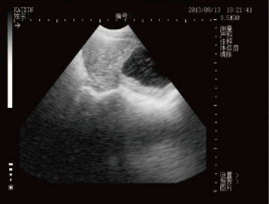 MSU2超音波圖像_子宮積液或蓄膿